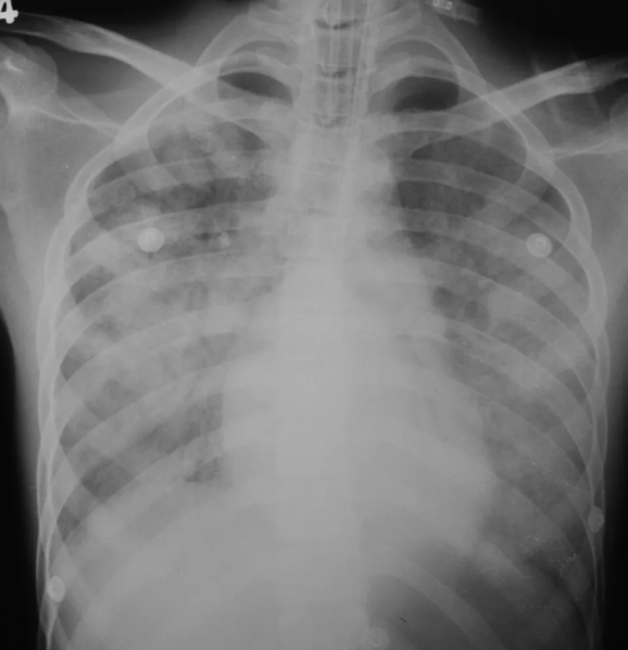 File:Diffuse pulmonary haemorrhages of the lungs infected by leptospirosis.png
