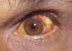 Human eye showing symptomatic red and yellow patches on the white of the eye