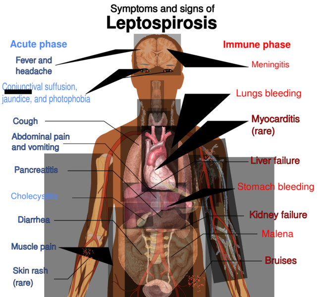 File:Signs and symptoms of leptospirosis.svg